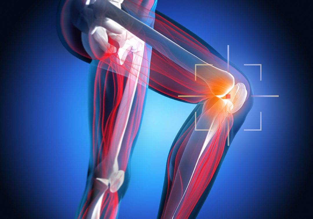 Arthrofibrose am Knie behandeln und heilen