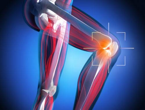 Arthrofibrose am Knie behandeln und heilen
