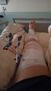 Arthrofibrose Komplikationen nach Knie-OP