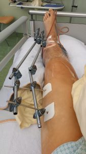Arthrofibrose Komplikationen nach Knie-OP