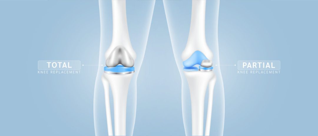 Schlittenprothese im Knie